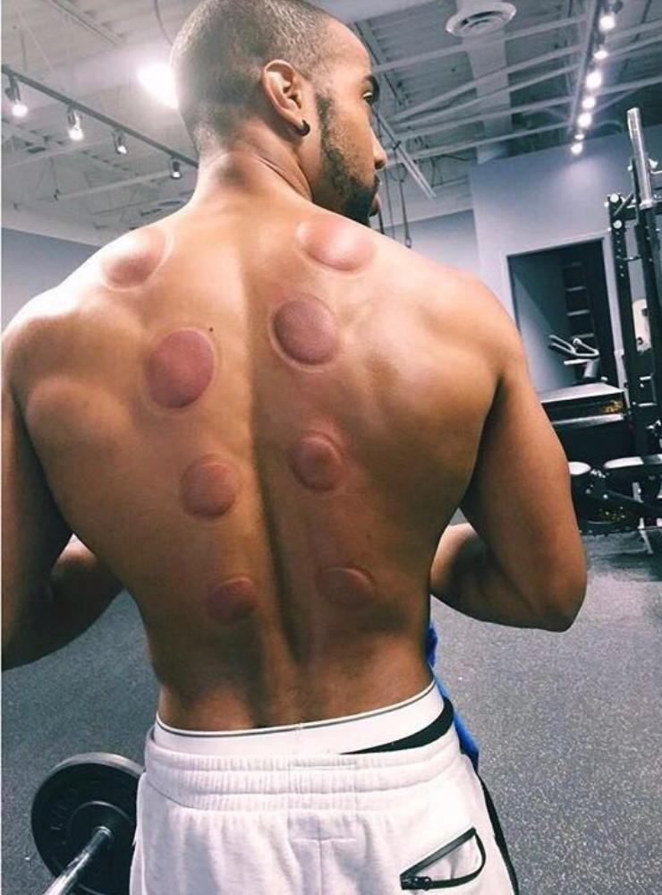 Sports Cupping & Hijama